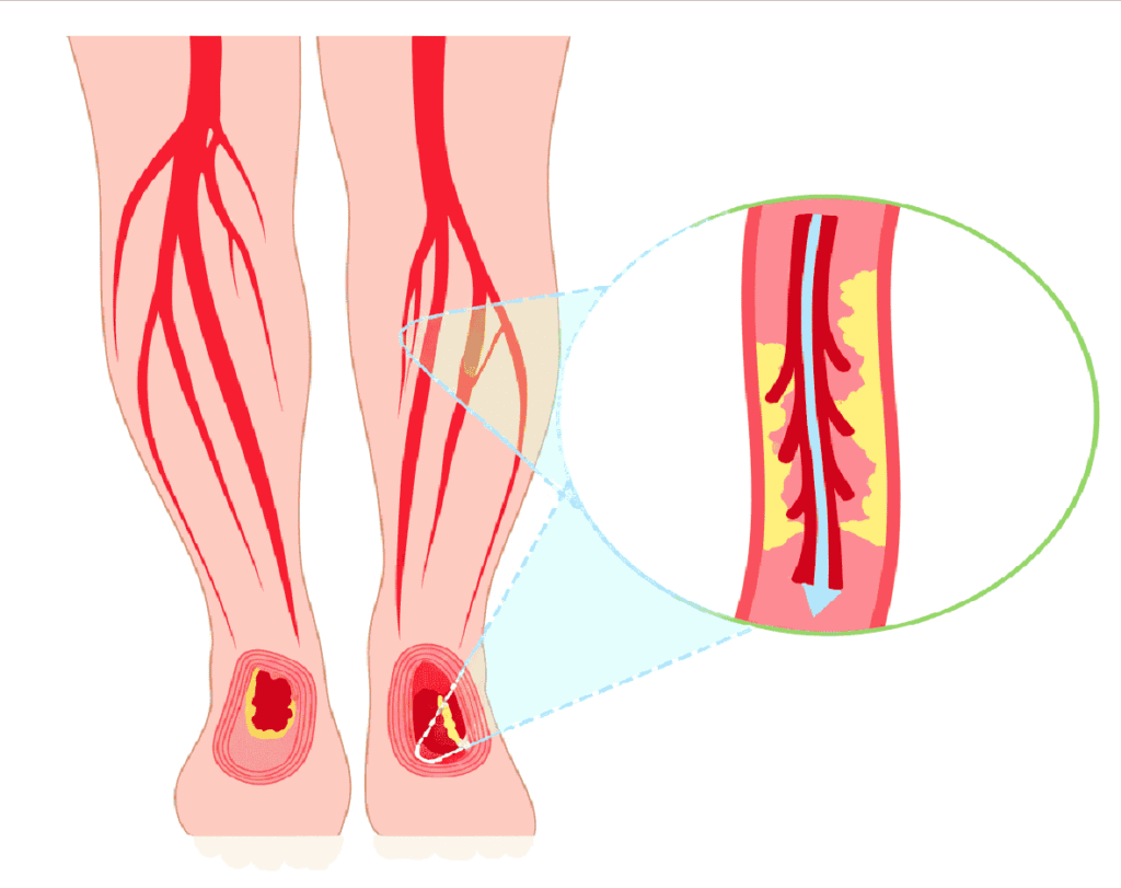 Peripheral artery disease treatment at Third Coast Vascular, helping Sheboygan patients improve circulation and manage leg pain with vascular care.